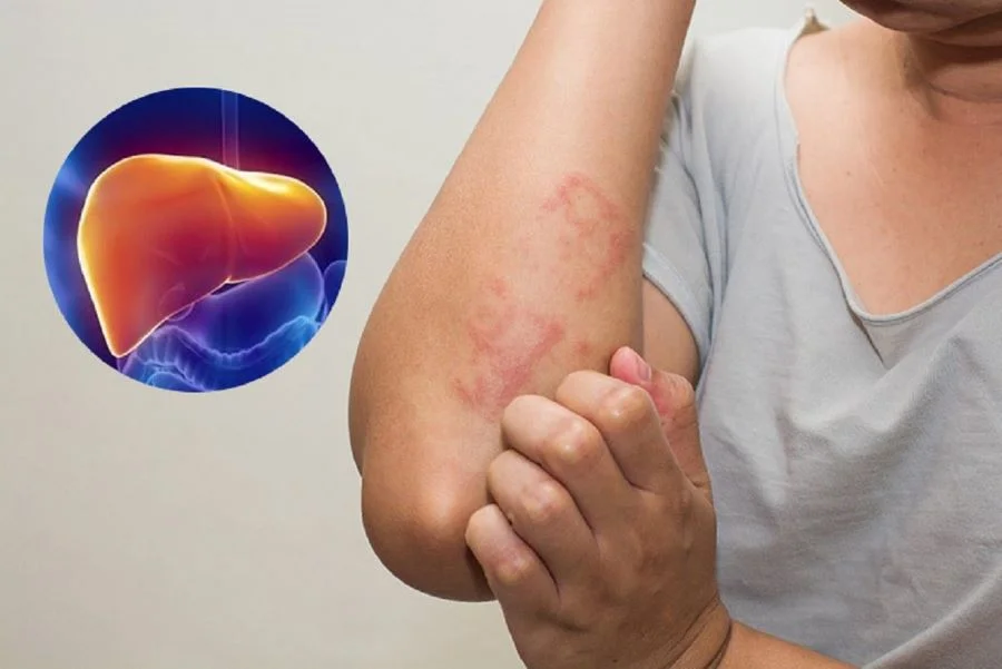 Cẩn trọng khi ăn hải sản khi tiền sử cơ thể bị dị ứng với hải sản.
